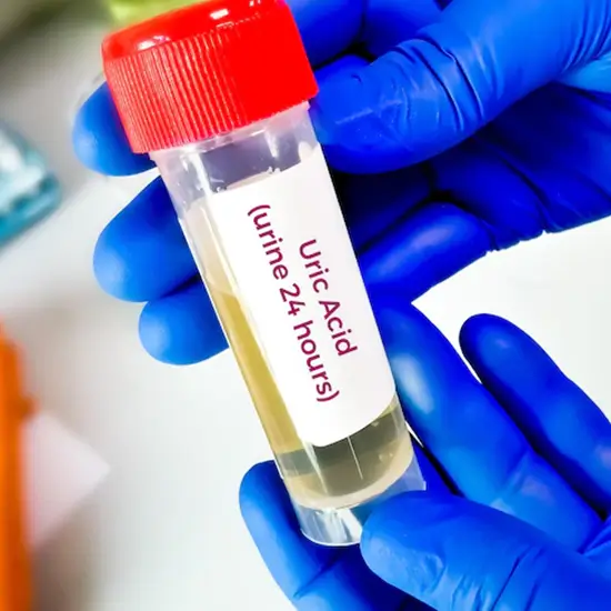 uric acid, 24 hour urine test